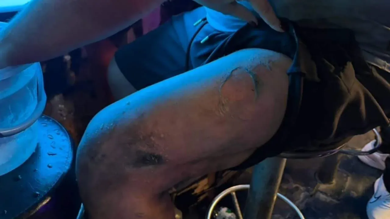 화상을 입은 벨기에 남성