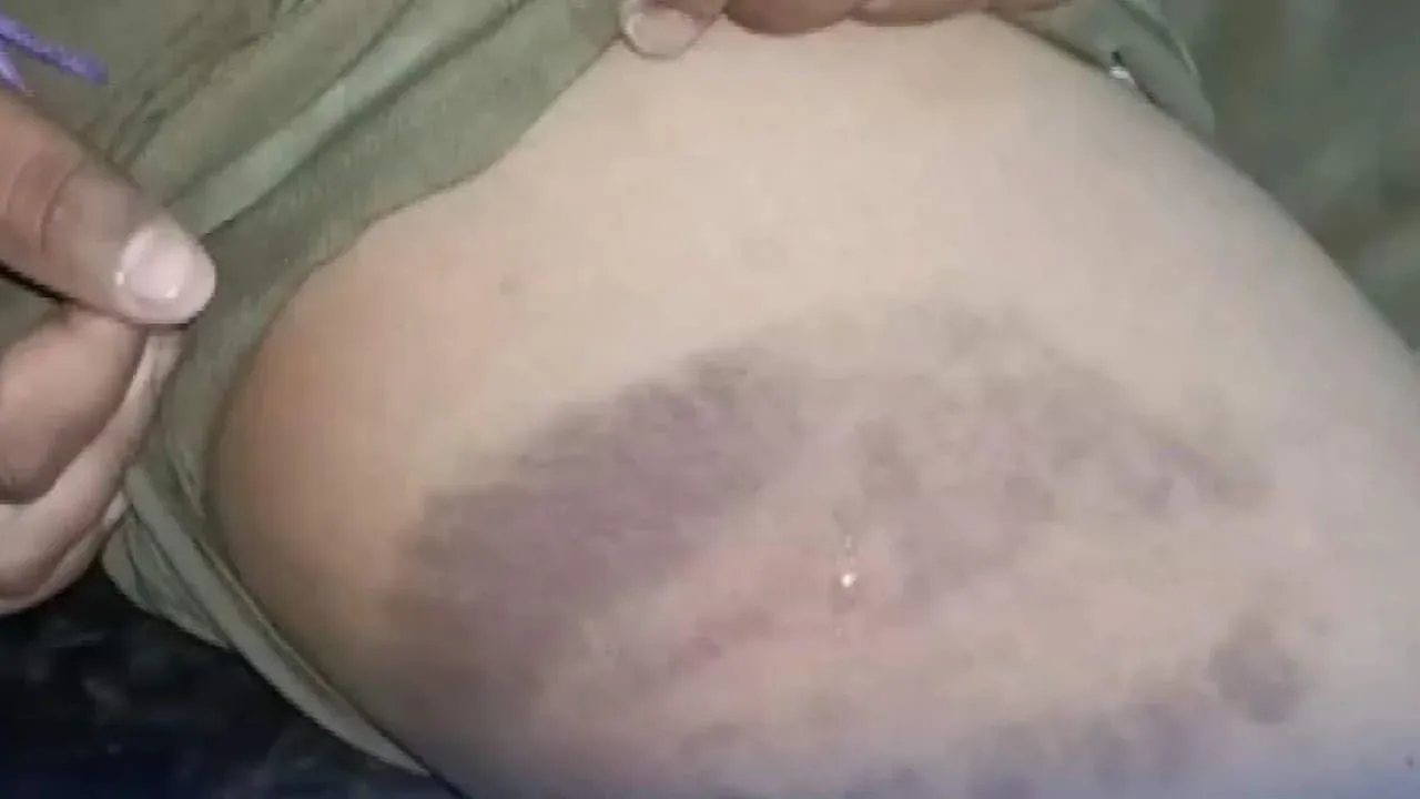 태국 쁘라찐부리 아동 학대 피해 소년의 팔과 다리에 남은 멍 자국