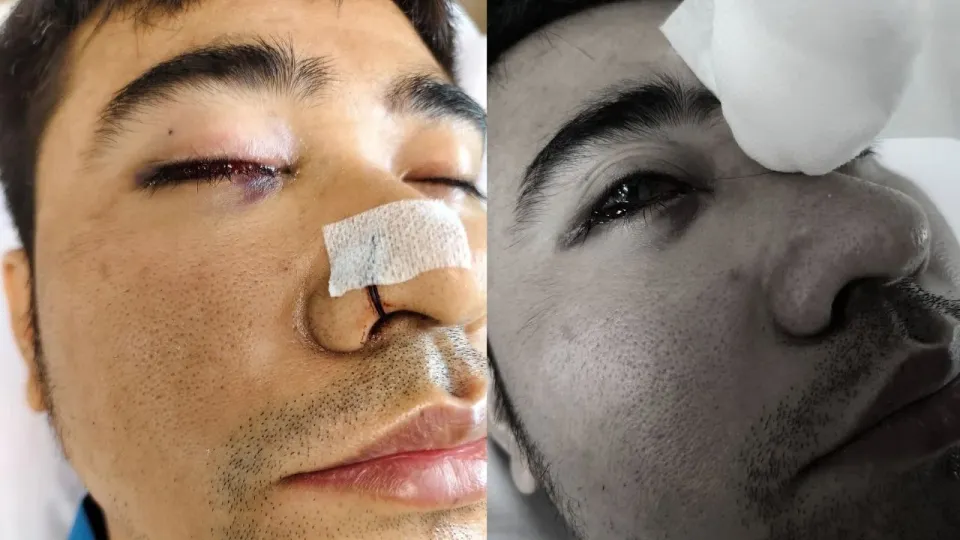 태국 사무트사콘 사설병원 수술 후 실명한 태국 남성